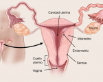 OSPAÑA y la concientización sobre el cáncer de ovario