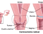 OSPAÑA y la prevención del cáncer de cuello uterino