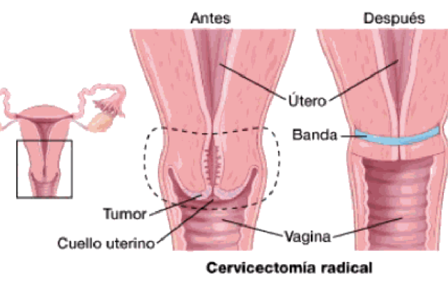 OSPAÑA y la prevención del cáncer de cuello uterino