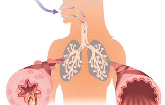 OSPAÑA y el tratamiento del asma