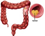 OSPAÑA y la prevención del cáncer de colon