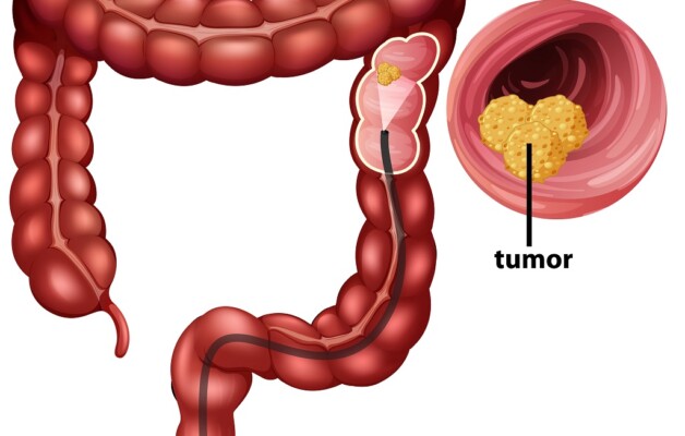 OSPAÑA y la prevención del cáncer de colon