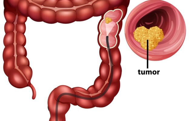 OSPAÑA y la prevención del cáncer de colon