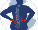 Ospaña y el tratamiento del dolor neuropático